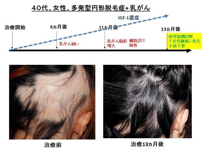 円形脱毛症　病院